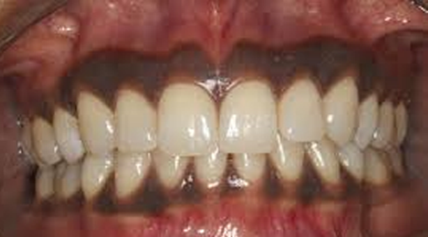 The Most Common Reasons You Have Black Gums