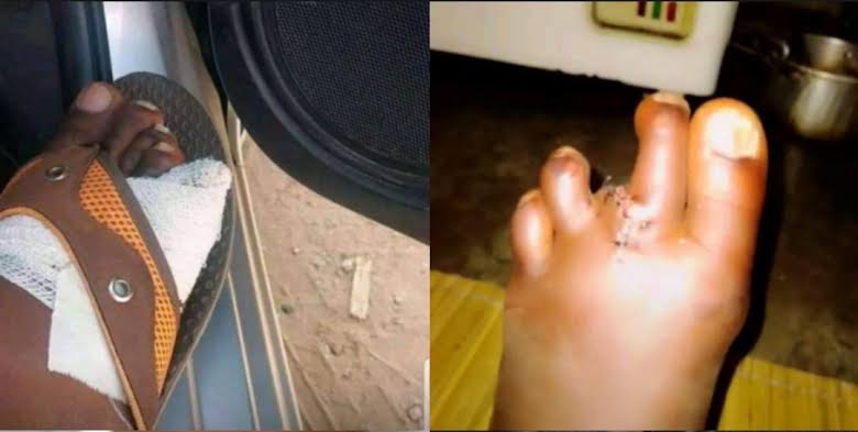 Zimbabweans Allegedly Selling Toes To Escape Tough Economic Situations 