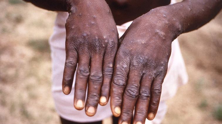 Uganda Heightens Alert Amidst Monkeypox Outbreak In DRC